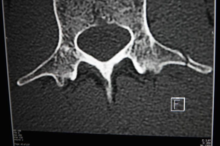 腰椎横突起の右側の骨折が判明した