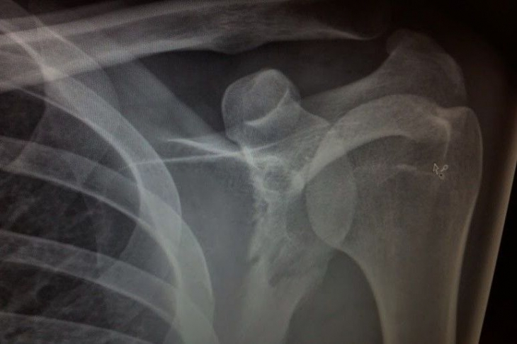 骨折部分のレントゲン写真