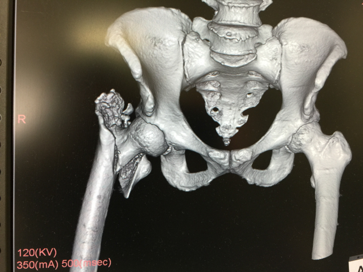 昨年の鈴鹿ロードでの大腿骨粉砕骨折のレントゲン写真　