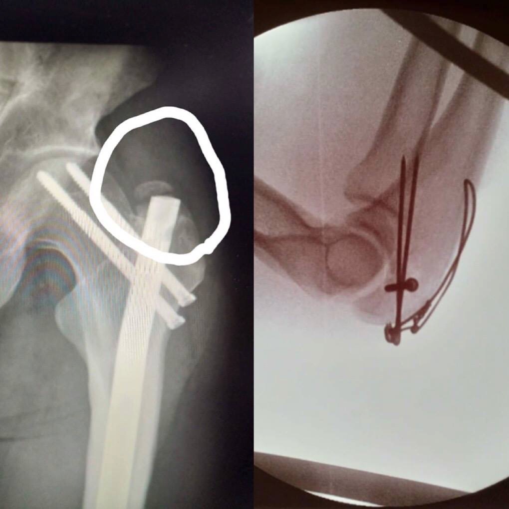 左：左大転子部裂離骨折（3年前に手術したスクリューの上部が剥離）、右：整復固定手術を行った左肘