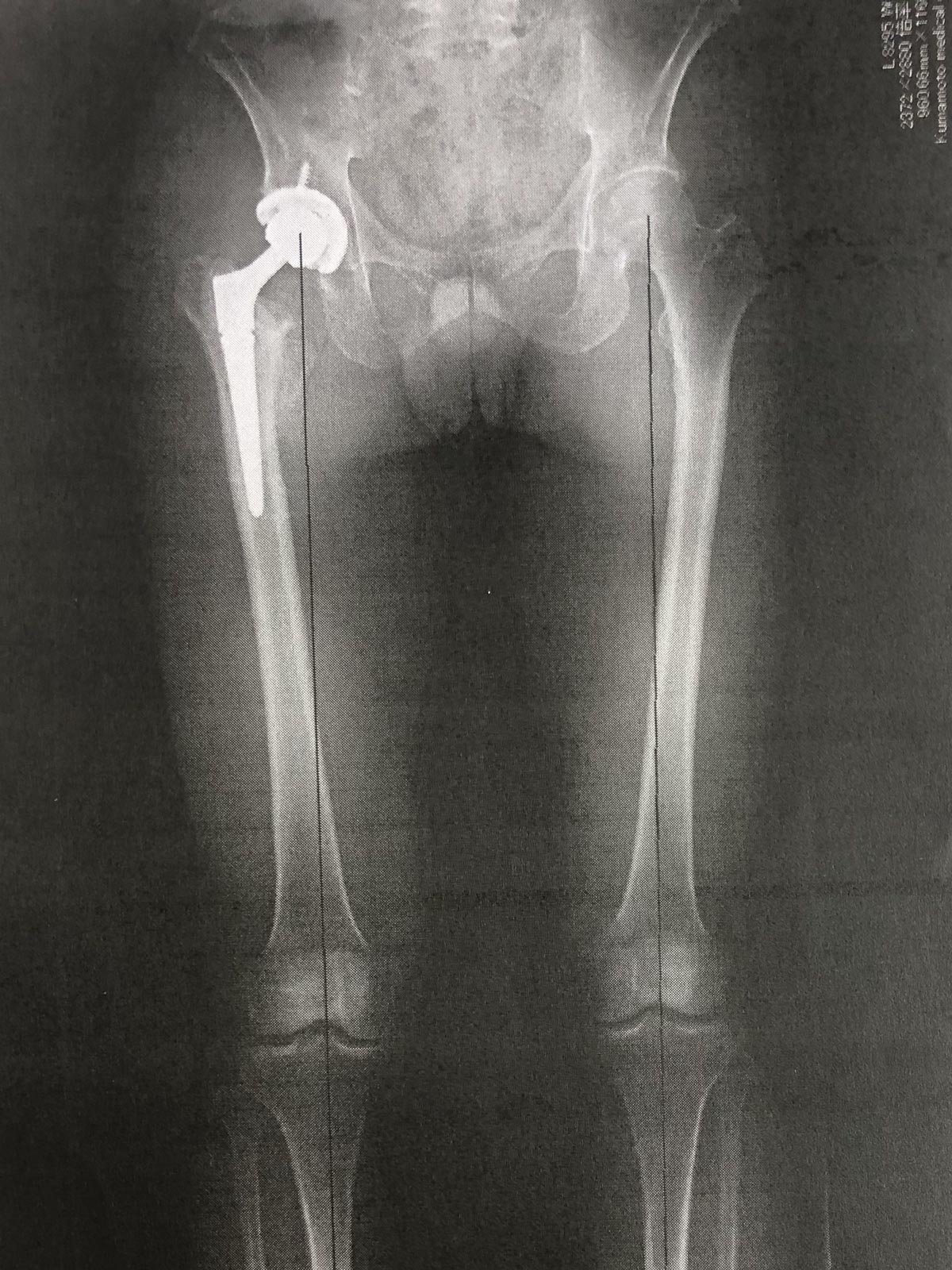 人工関節を入れると、2.5cm短かった右脚が術後に揃った